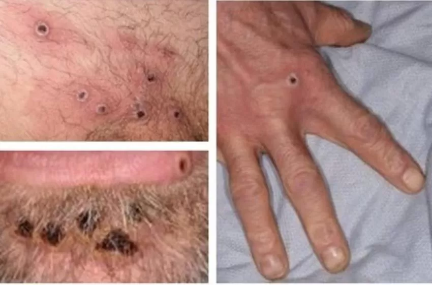 España registra 800 casos confirmados de viruela del mono, uno de ellos en la Región de Murcia