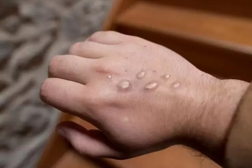 Los casos de viruela del mono se triplican en Europa en las últimas dos semanas