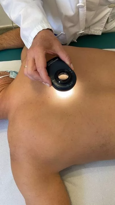 Salud recomienda la autoexploración frecuente para detectar precozmente el cáncer de piel