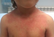 ¿Qué es la Escarlatina?