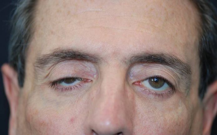 efectos de la miastenia gravis en la vida de las personas