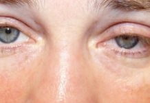 Crisis miasténica causantes de la crisis miastenica