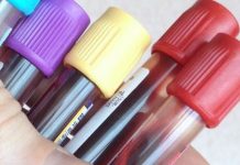 Serologia mononucleosis