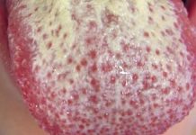 Hongos en la lengua o Candidiasis en la lengua