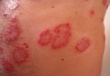 Dermatitis por estrés: síntomas y cuidados